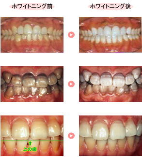 ホワイトニング術前・術後