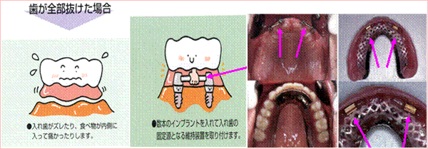 歯が全部抜けた場合