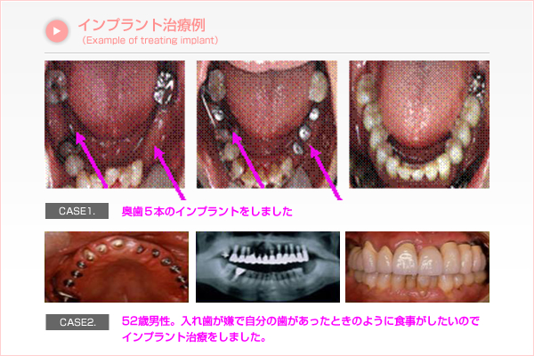 インプラント治療例