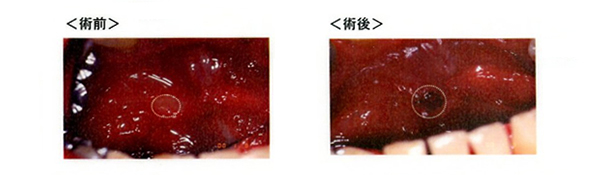 口内炎への影響